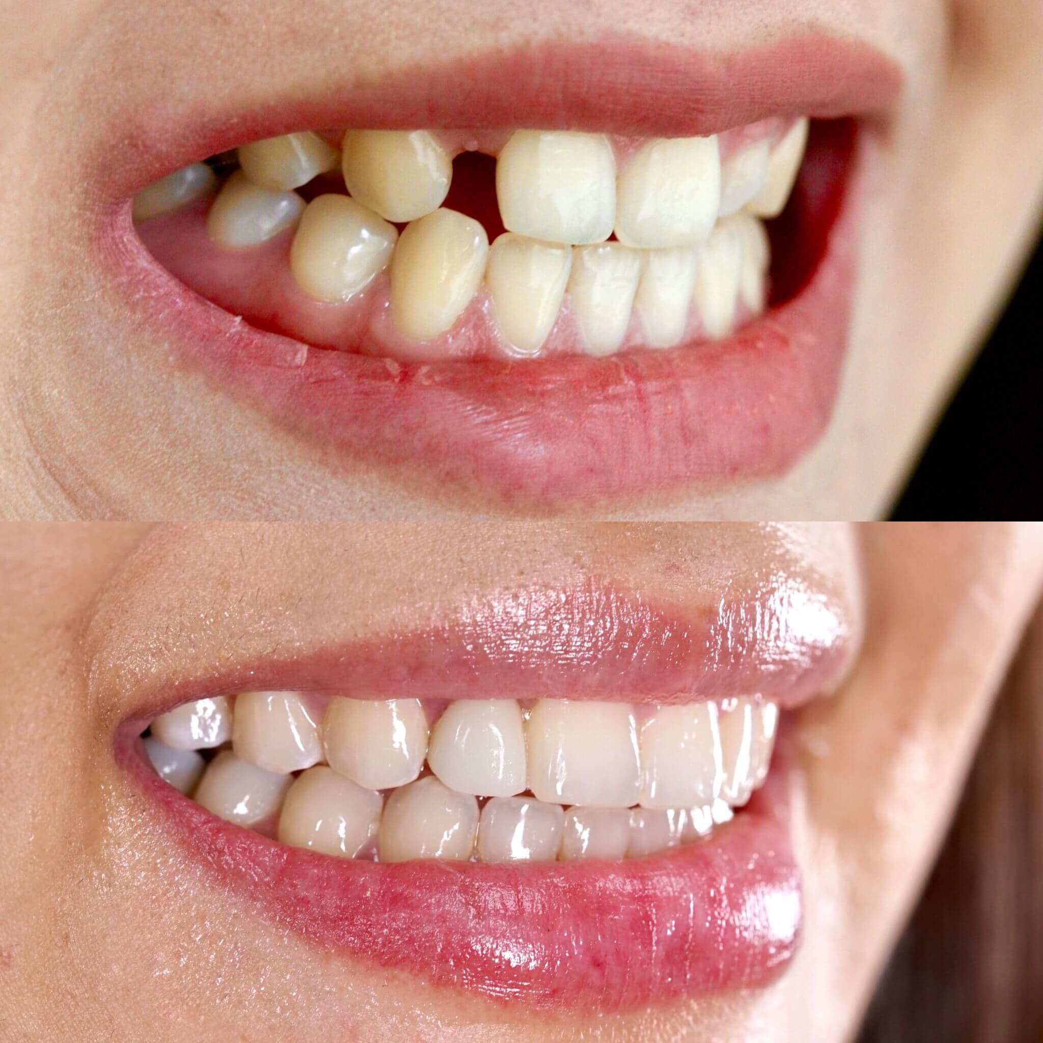 Transformare dentară - Înainte și după