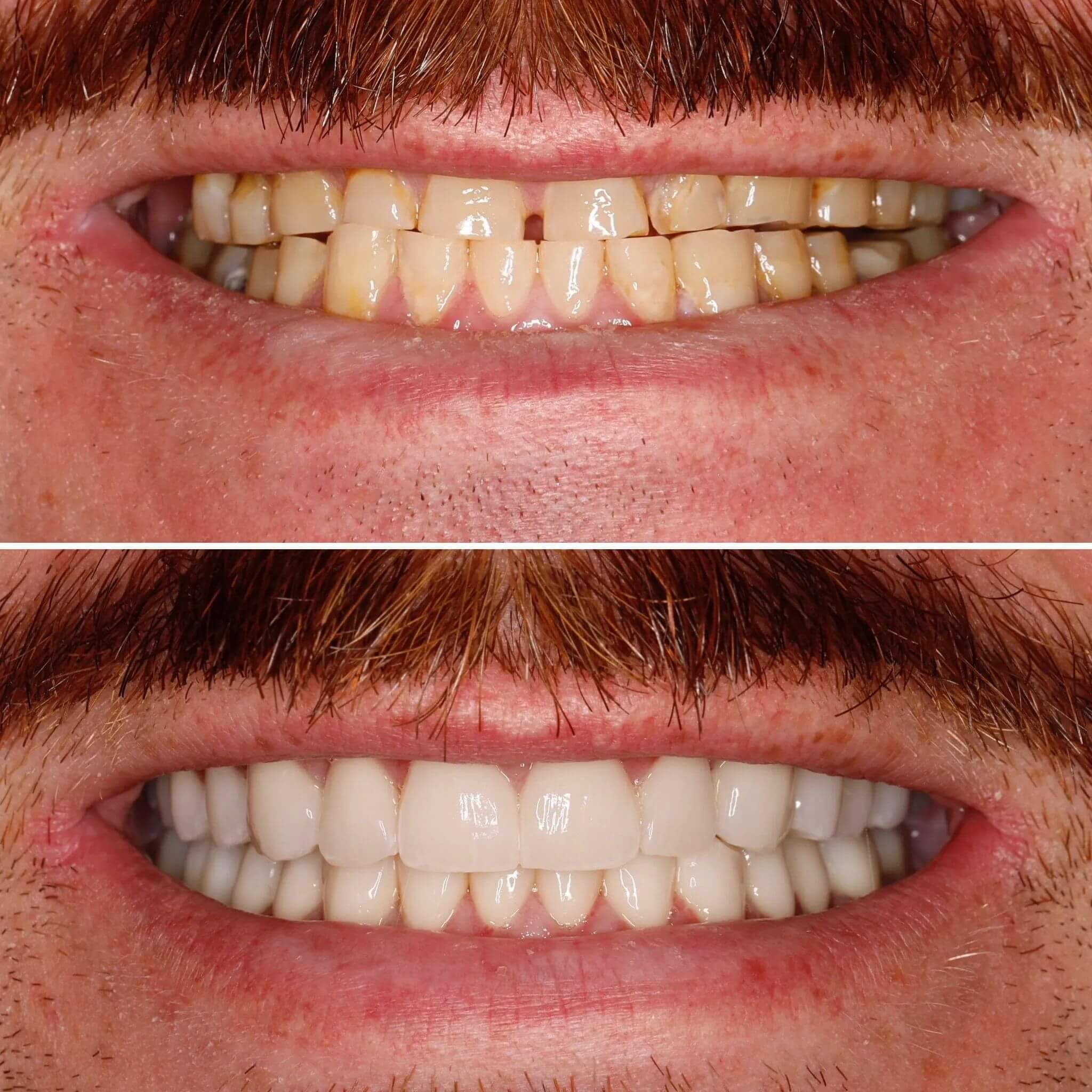 Transformare dentară - Înainte și după